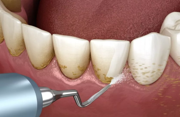 서울 직장인 구강검진, "바쁘다고 미루면" 생기는 변화 관련 이미지 5
