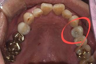 국산임플란트를 선택한 이유, 치료사례 공개합니다 관련 이미지 12