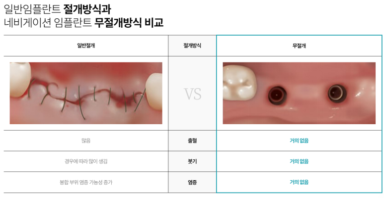네비게이션임플란트가격, 일반 임플란트보다 비싼 이유? 관련 이미지 5