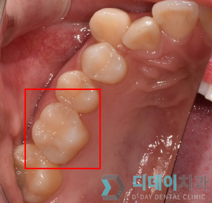 강남충치치료? 티 안나는 "인레이" 치료 사례 관련 이미지 6