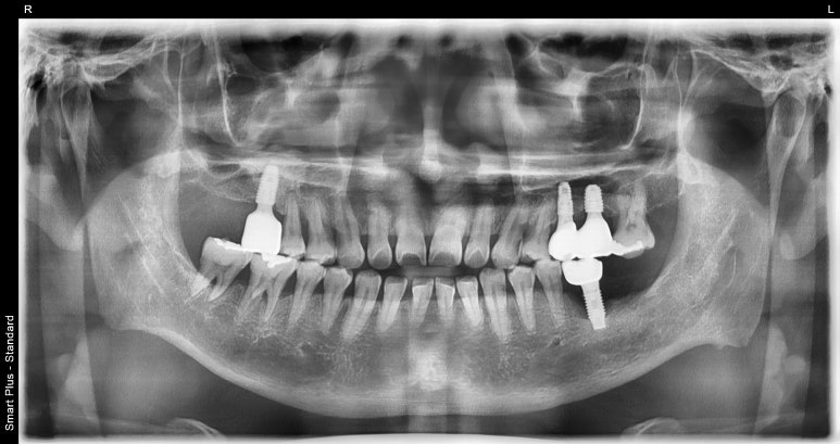 상악동거상술과 뼈이식임플란트 실제 치료사례로 보여드립니다. 관련 이미지 7