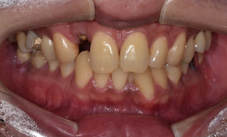 20대임플란트 수명? 평생 못쓸수도 있습니다. 관련 이미지 3