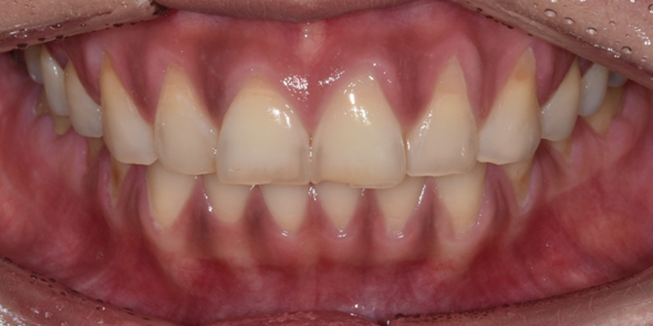 20대잇몸퇴축? 이식수술만이 답은 아닙니다. 관련 이미지 2