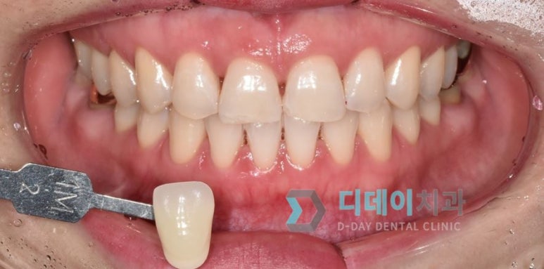 강남치아미백, 금세 또 착색되는 이유와 원데이 치료사례 관련 이미지 3