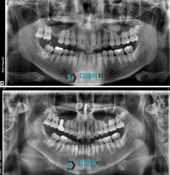 언주역임플란트, 뼈이식 필수일까? 의사가 직접 설명합니다 관련 이미지 2