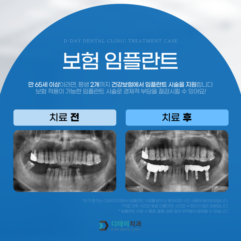 임플란트뼈이식도 보험이 되나요? 전문의가 알려드립니다. 관련 이미지 3