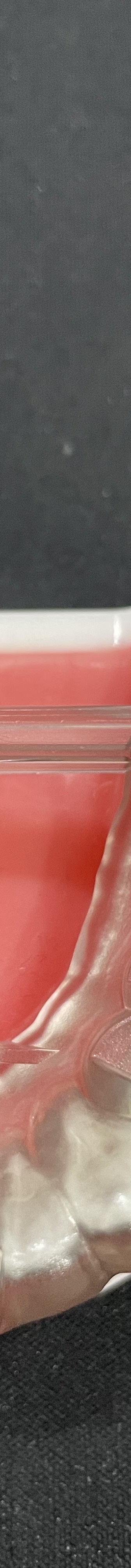 강남역 치과 임플란트 수면마취?해야만 하는 경우 관련 이미지 12