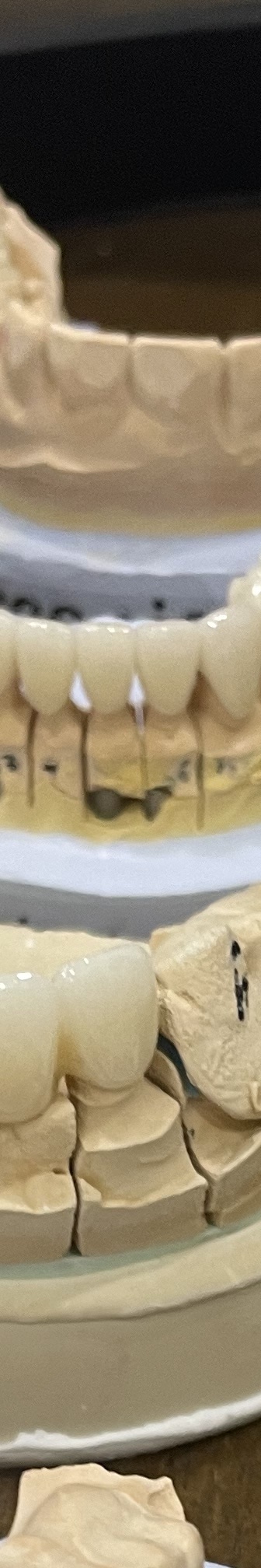 매봉역 치과, 자연치아 잃고 싶지 않다면? 관련 이미지 10