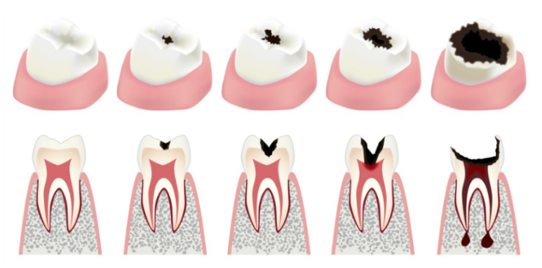 서울 직장인 구강검진, "바쁘다고 미루면" 생기는 변화 관련 이미지 4