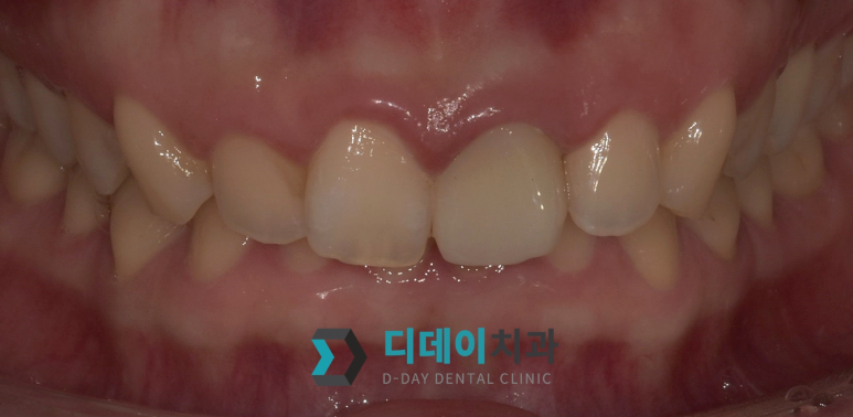 치아쪼개짐, 바로 치과 안가면 신경치료까지 갑니다 관련 이미지 7