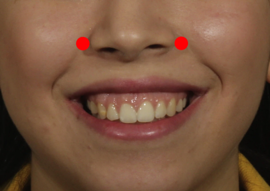 Sports Complex Station Dentist: Gum Contouring—Have You Ever Started Disliking Your Smile? image 3