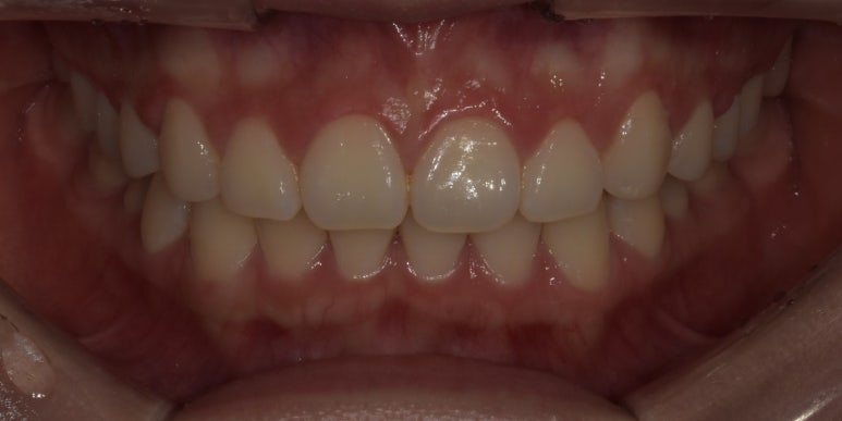 잇몸비대칭, 30분만에 개선하는 방법과 최근 치료사례 공유 관련 이미지 7