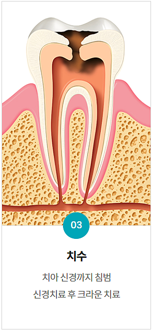 충치치료 기간, 과정, 비용까지 전문의가 알려드립니다. 관련 이미지 9