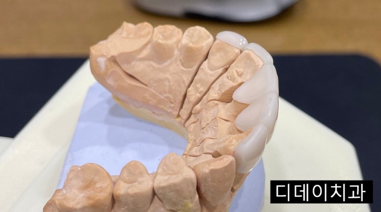 무삭제라미네이트 누구나 다 된다? 속지마세요. 관련 이미지 11