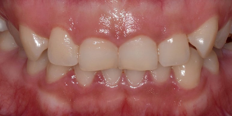 웃을 때 잇몸이 많이 보인다면, 몰라서 못하는 이것 관련 이미지 9