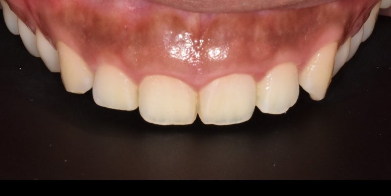 잇몸착색, 변색되어 검은 잇몸 선홍빛으로 되돌리는 방법 관련 이미지 2