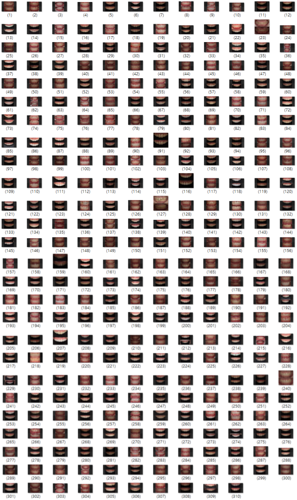 300명의 잇몸성형 경험자가 말하는 장단점? 관련 이미지 1