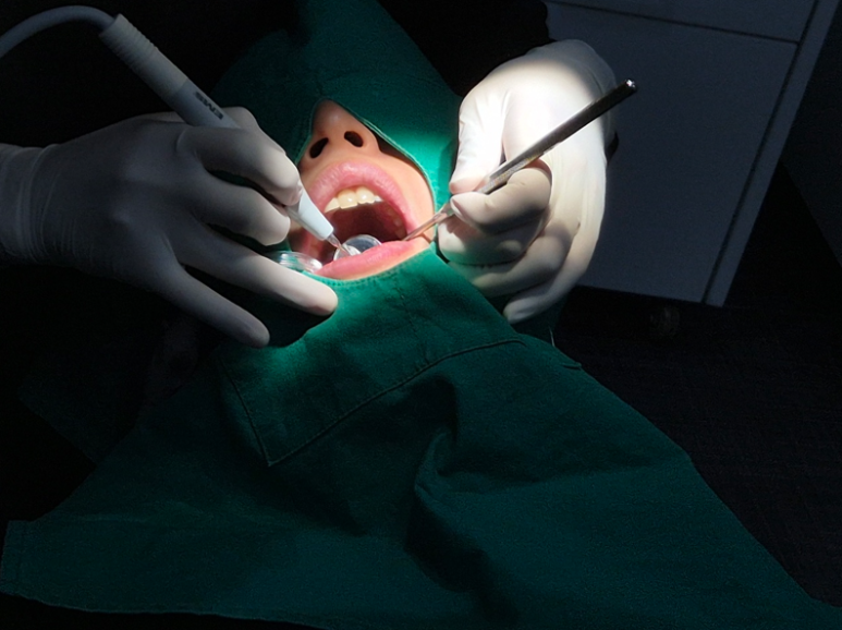 앞니뿌리충치, 치료과정 정리해드립니다. 관련 이미지 5