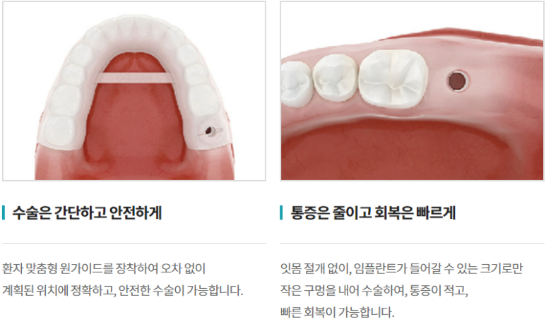 당뇨임플란트, 관련 이미지 4