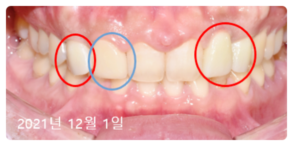 앞이빨임플란트? 3가지 원칙부터 확인하세요. 관련 이미지 5