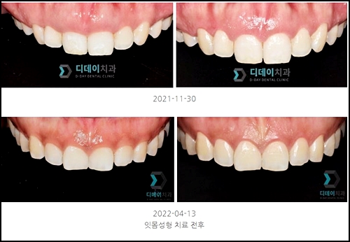 잇몸절제술? 답답한 인상이 고민입니다... 관련 이미지 3