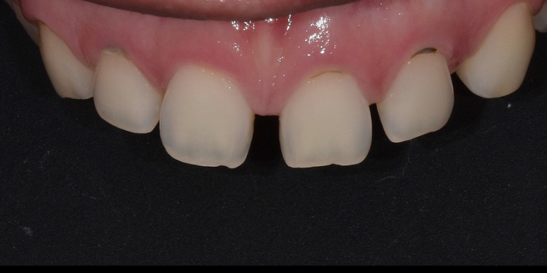 라미네이트 전후 비교, 주의사항, 비용까지 총정리 관련 이미지 3