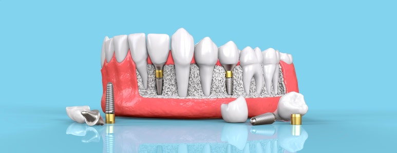 국산임플란트재료? 가격 걱정이 있으시다면 확인하세요. 관련 이미지 4