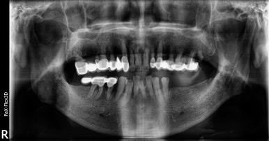 보험임플란트, 임플란트브릿지로 치료한 사례 보여드립니다. 관련 이미지 2