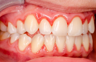 Apgujeong Rodeo Station Dental Clinic: If Your Gums Bleed, Never Ignore It image 4