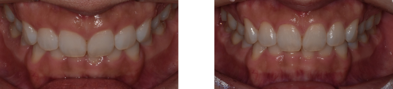 잇몸성형 비용, 통증, 회복기간, 후기까지 총정리 관련 이미지 4