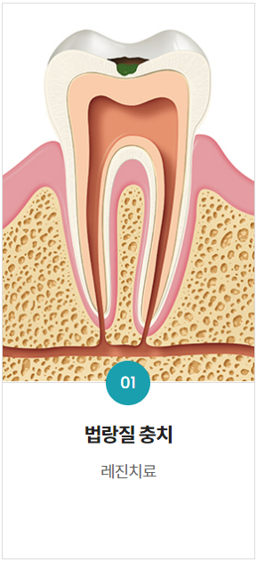 치과레진가격, 진솔하게 공개합니다. (+좋은치과 찾는 팁) 관련 이미지 3