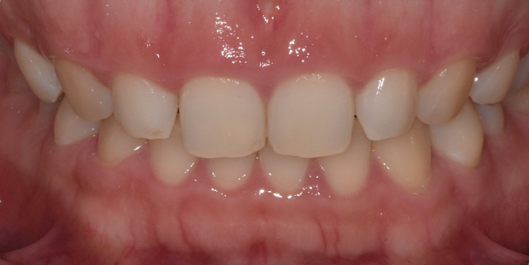 선릉치과? 치료받기 전에 꼭 알아야 할 것 관련 이미지 10