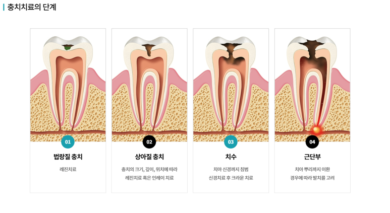아말감 레진 인레이 어떤 차이? 속시원하게 알려드릴게요. 관련 이미지 3