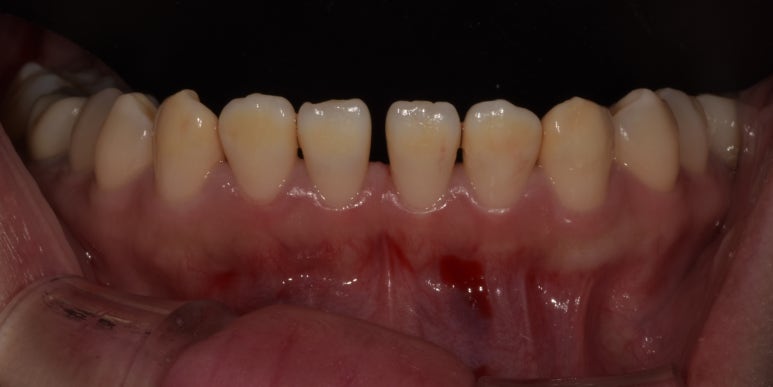 아랫니라미네이트, 잘하는 치과 찾는 2가지 기준 의사 작성 관련 이미지 3