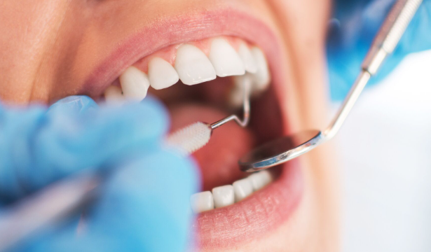 치아미백 지속기간,가격, 부작용, 횟수, 총정리 해드립니다. 관련 이미지 5