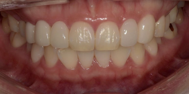 앞니브릿지와 라미네이트를 같이 해도 자연스러울까? 사례로 보여드립니다. 관련 이미지 6