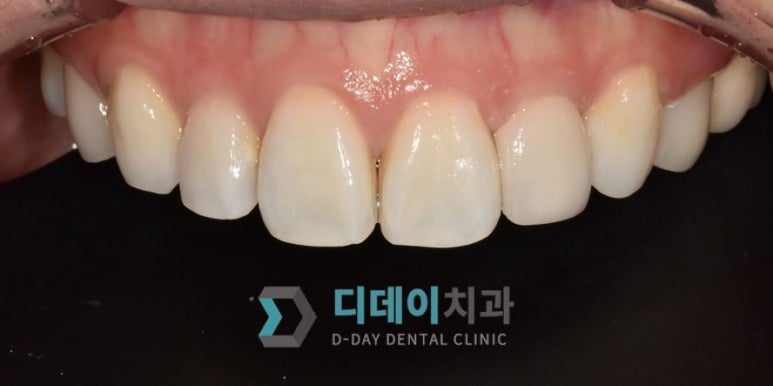 작은이빨, 왜소치? 치아 크기를 키우고 싶은 분만 <필독> 관련 이미지 6