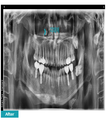 원데이임플란트? 결국 중요한 것은 XX 입니다 관련 이미지 2