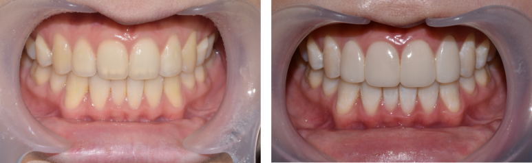 치아미백주의사항과 비용, 셀프미백과의 차이점까지 전부 설명드립니다. 관련 이미지 4