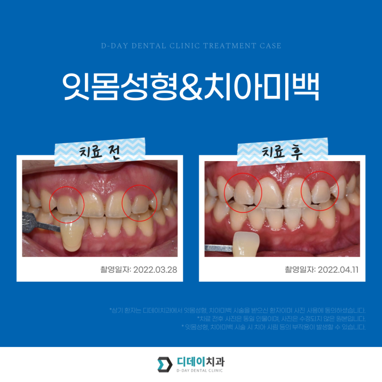 치과치아미백, 700명 이상이 디데이치과를 선택한 이유? 관련 이미지 4