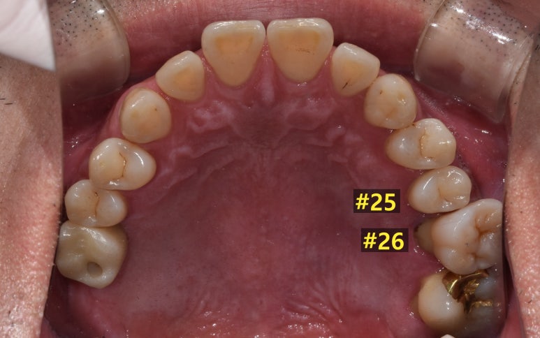 상악동거상술과 뼈이식임플란트 실제 치료사례로 보여드립니다. 관련 이미지 3