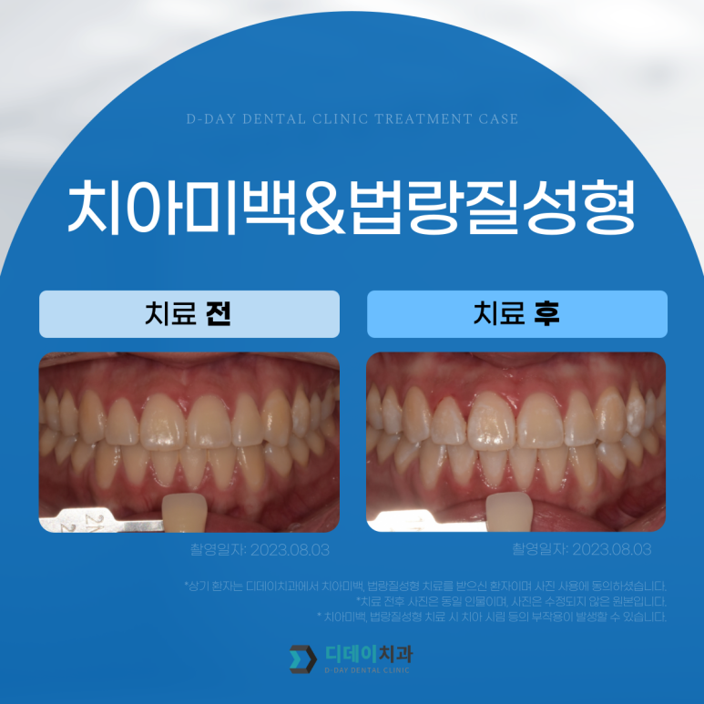 웨딩촬영치아미백? 자신있게, 환하게 웃을 수 있는 꿀팁 관련 이미지 10
