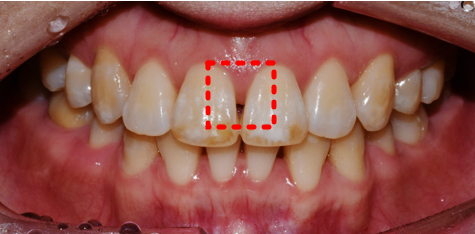 서울라미네이트? 전문의가 설명드립니다. 관련 이미지 2