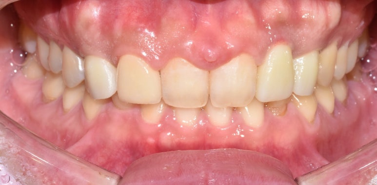 네비게이션임플란트, 무조건 성공하는 것은 아닌 이유? 관련 이미지 7