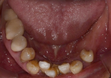 보험임플란트, 임플란트브릿지로 치료한 사례 보여드립니다. 관련 이미지 3