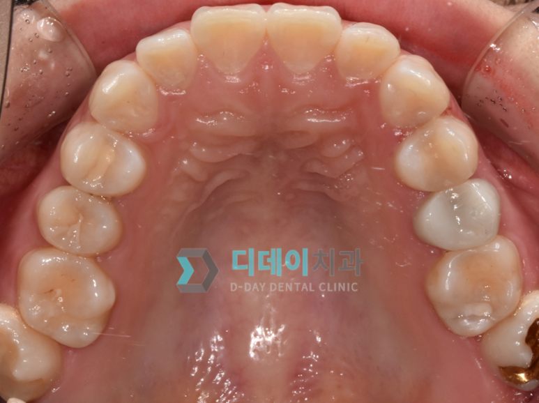 충치치료기간, 치료별 내원횟수와 기간까지 총정리 관련 이미지 7