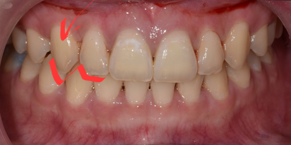 법랑질성형, 앞니 치아모양이 고민이라면 관련 이미지 5