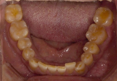 치아도 녹아내린다? 치아부식 원인과 치료방법은? 관련 이미지 2