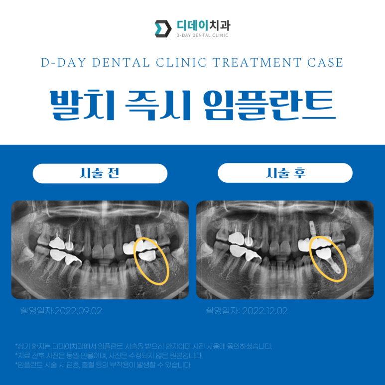 원데이임플란트, 정말 하루만에 가능할까요? 관련 이미지 2