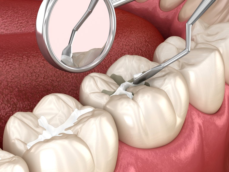 충치치료 기간, 과정, 비용까지 전문의가 알려드립니다. 관련 이미지 11